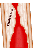 Cholesterol in artery